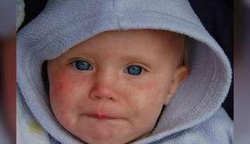 Child with measles by Dave Haygarth via Flickr