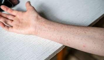 Measles rash. (Photo by Natalya Maisheva/iStock / Getty Images Plus)