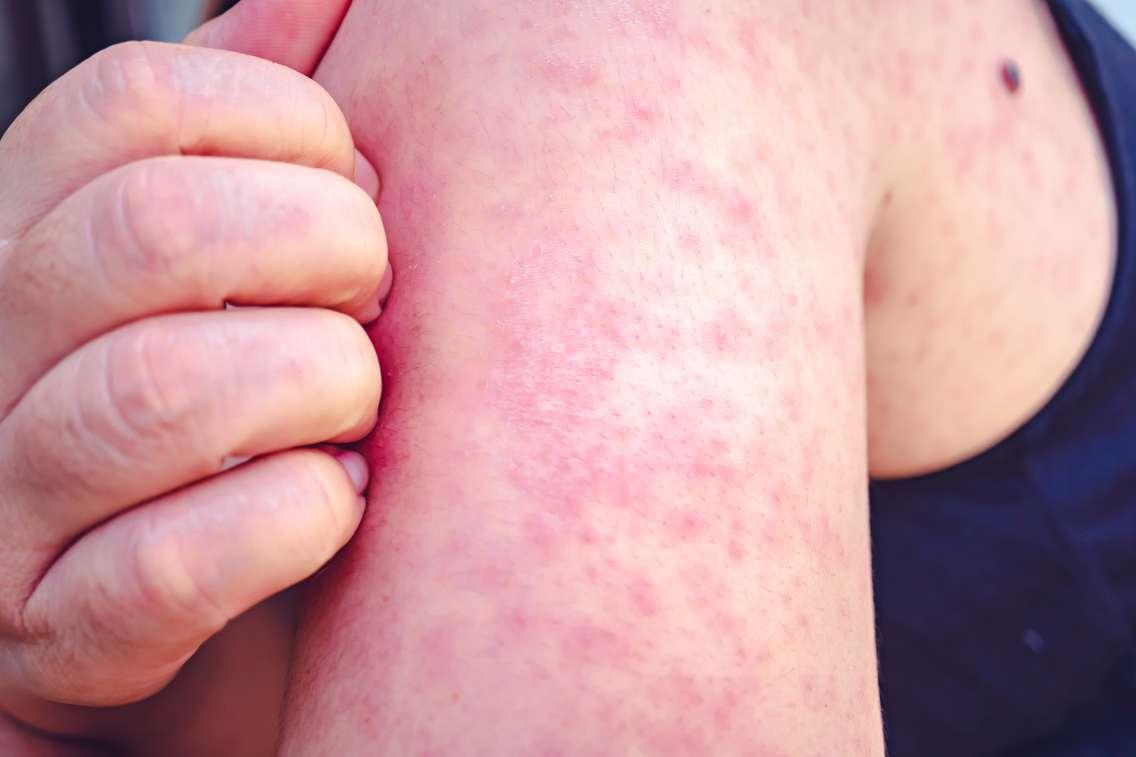 Measles rash. (Photo by Singjai20/iStock / Getty Images Plus)