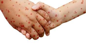 Measles.  © Can Stock Photo / focalpoint