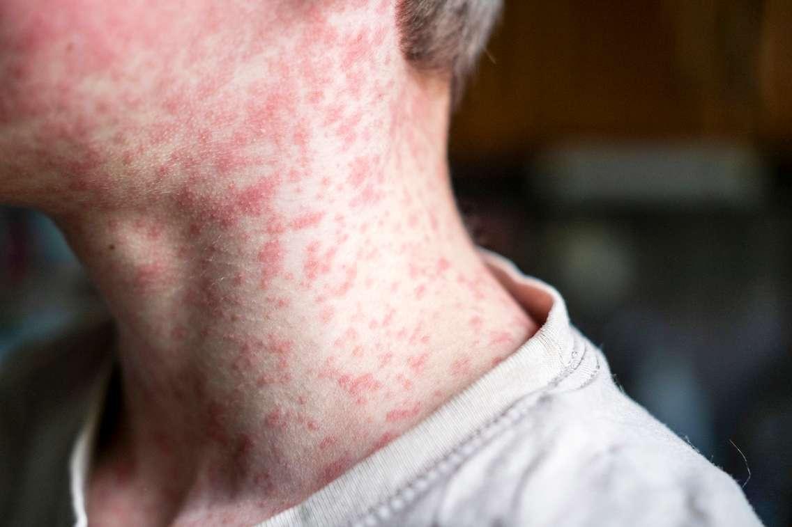 Measles rash. (Photo by Natalya Maisheva/iStock / Getty Images Plus)